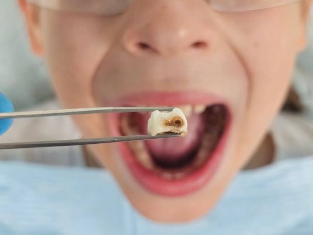 Best Emergency Tooth Extraction in Bentleyville, PA
